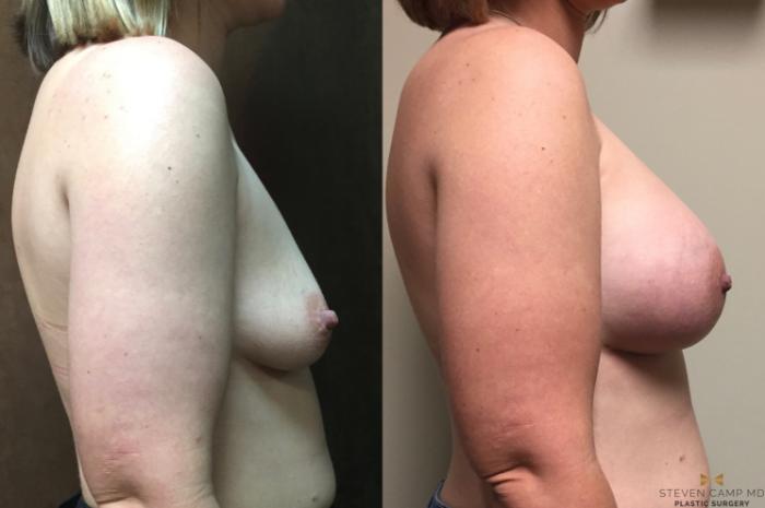 Before & After Breast Augmentation Case 47 View #5 View in Fort Worth, Texas