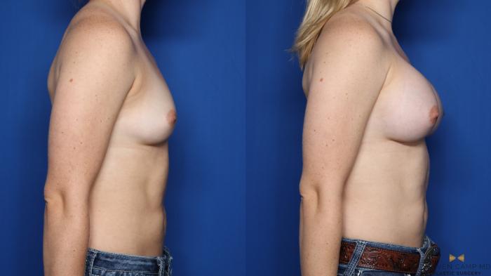 Before & After Breast Augmentation Case 474 Right Side View in Fort Worth & Arlington, Texas
