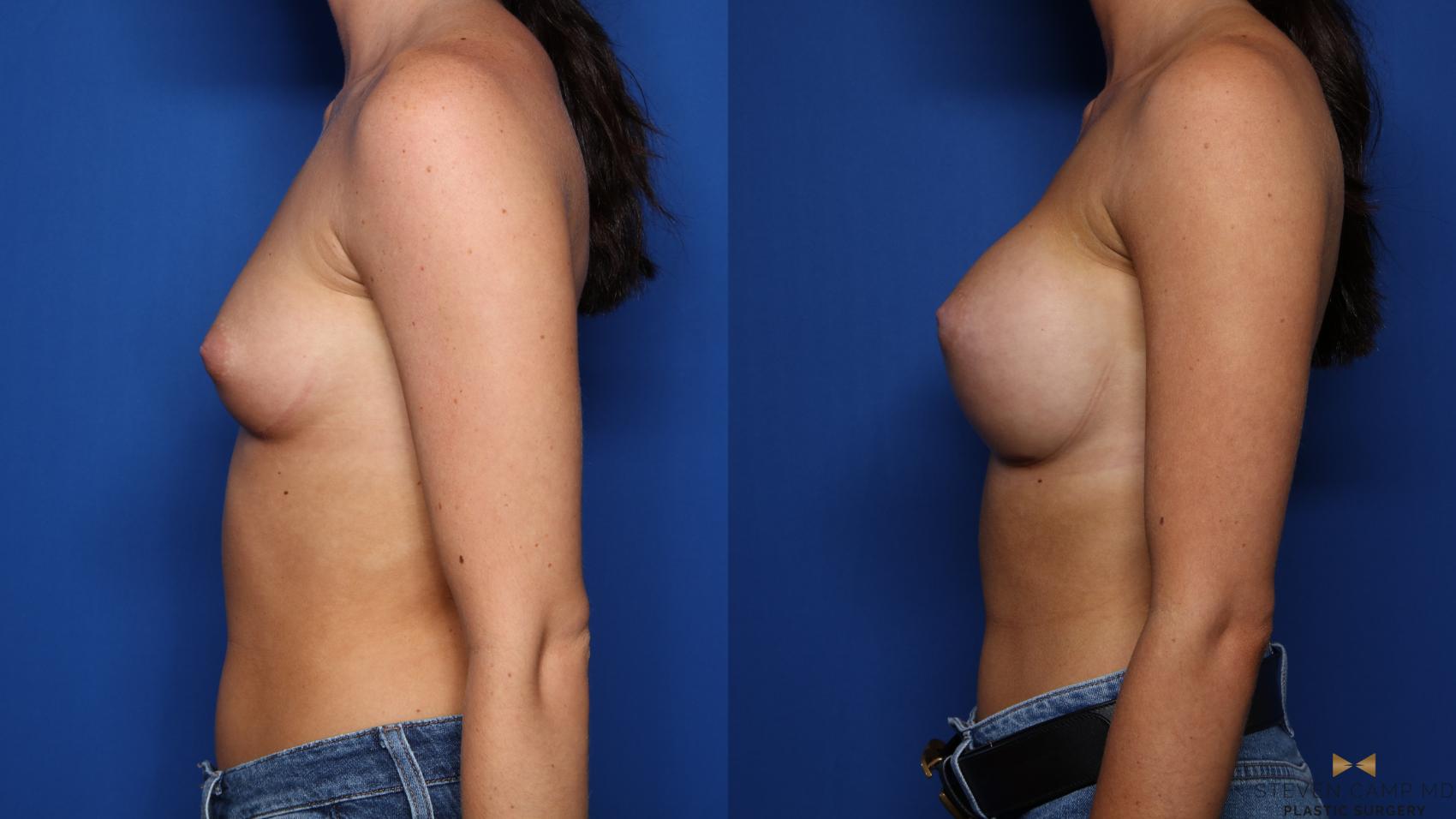 Before & After Breast Augmentation Case 475 Left Side View in Fort Worth, Texas