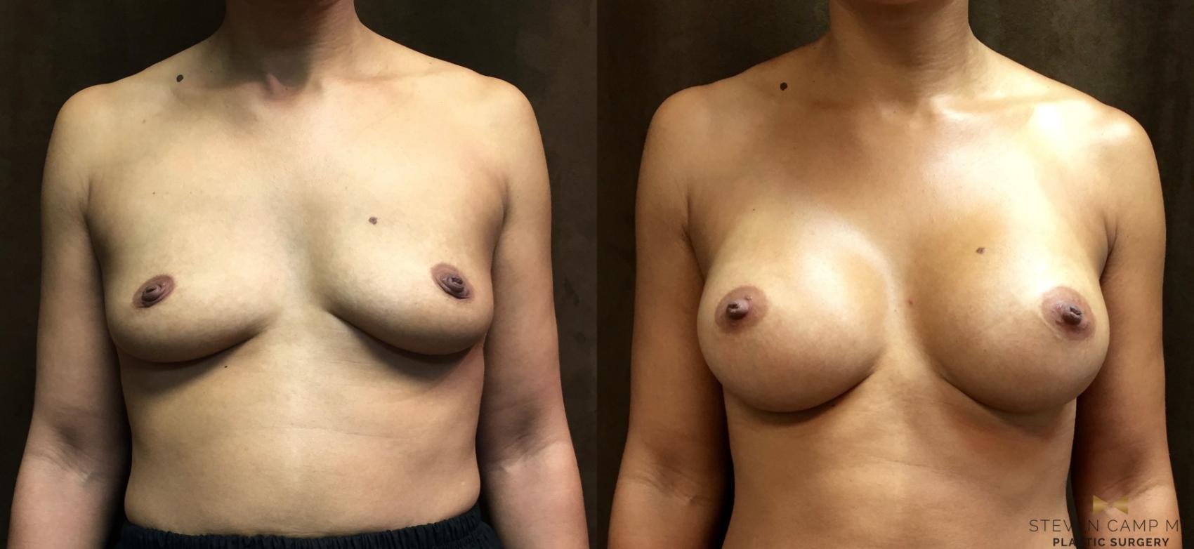 Before & After Breast Augmentation Case 48 View #1 View in Fort Worth, Texas