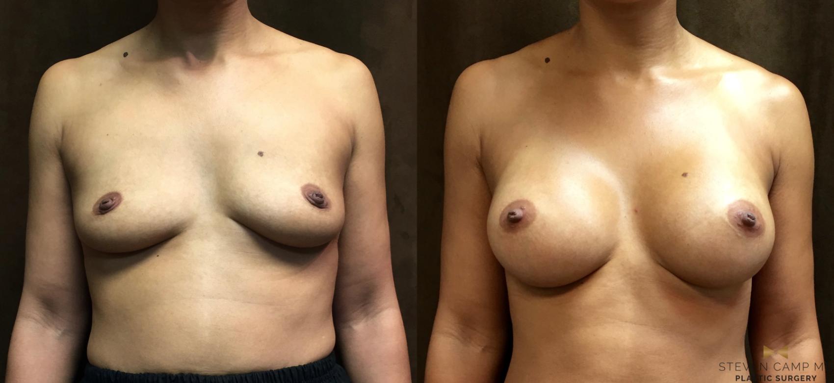 Before & After Breast Augmentation Case 48 View #1 View in Fort Worth & Arlington, Texas