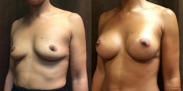 Before & After Breast Augmentation Case 48 View #2 View in Fort Worth, Texas
