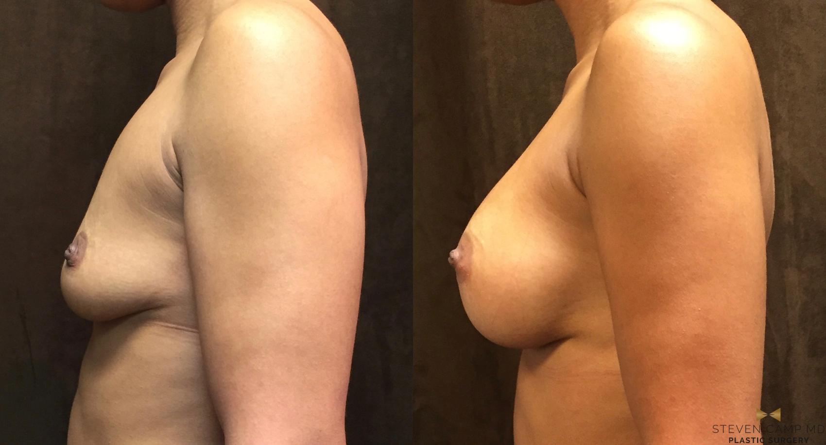 Before & After Breast Augmentation Case 48 View #3 View in Fort Worth, Texas