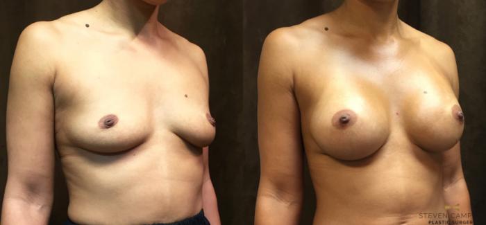 Before & After Breast Augmentation Case 48 View #4 View in Fort Worth, Texas