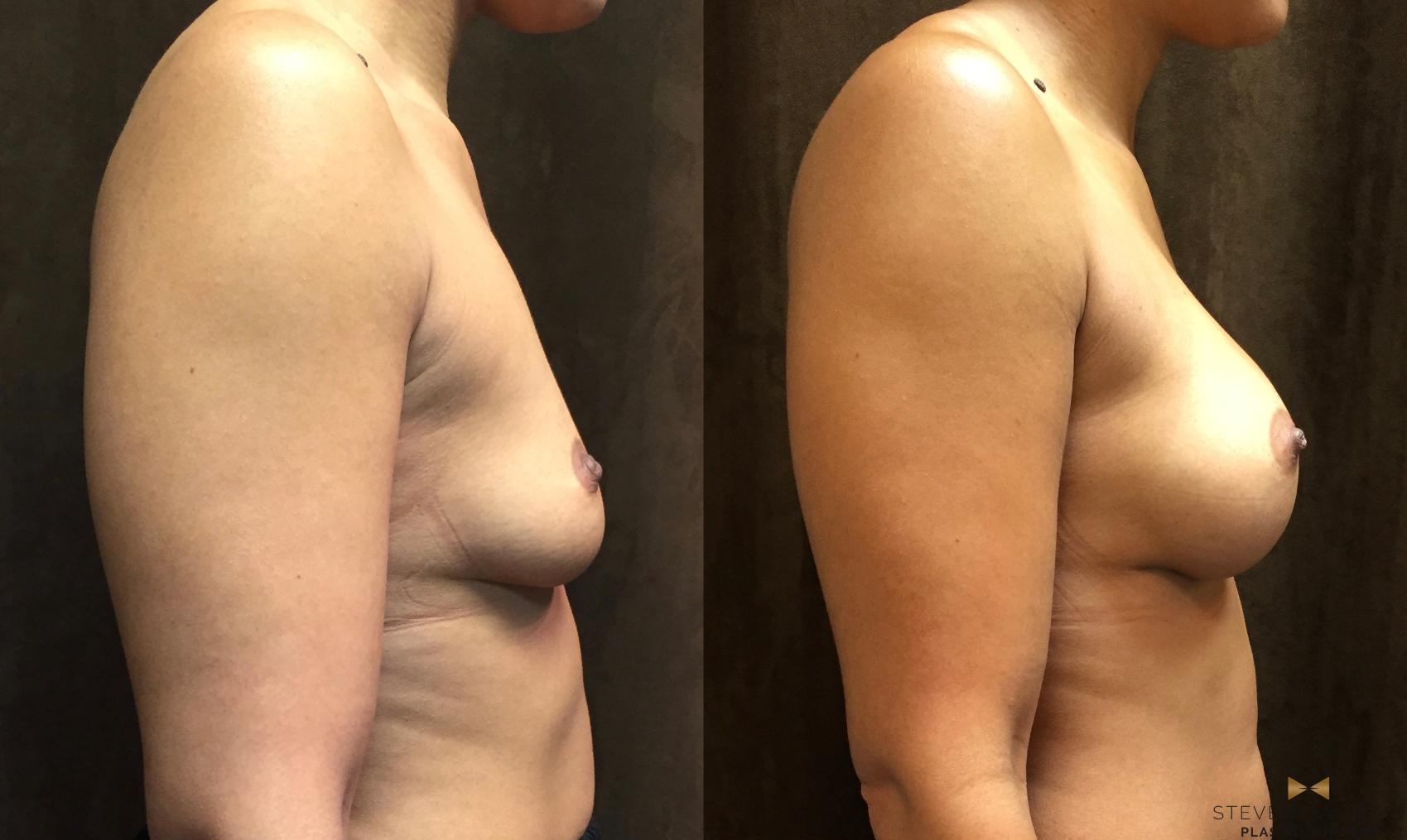 Before & After Breast Augmentation Case 48 View #5 View in Fort Worth, Texas