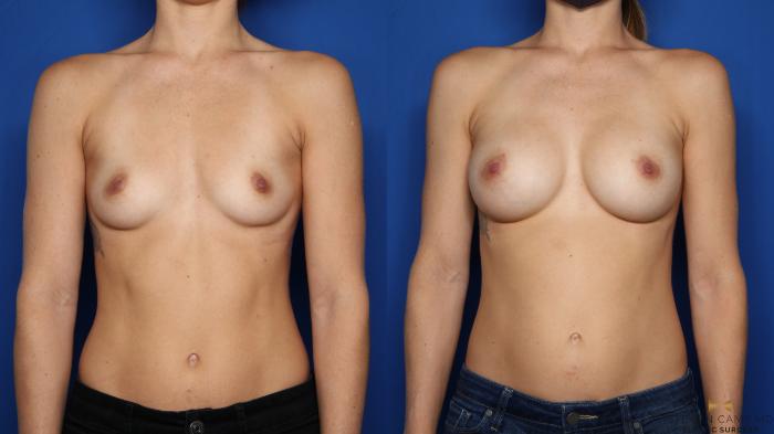 Before & After Breast Augmentation Case 482 Front View in Fort Worth & Arlington, Texas