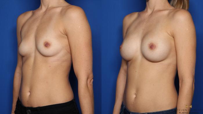 Before & After Breast Augmentation Case 482 Left Oblique View in Fort Worth & Arlington, Texas