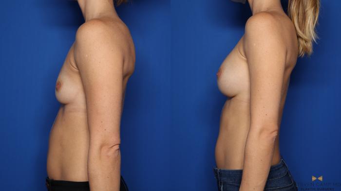 Before & After Breast Augmentation Case 482 Left Side View in Fort Worth & Arlington, Texas