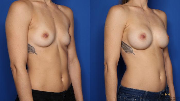 Before & After Breast Augmentation Case 482 Right Oblique View in Fort Worth & Arlington, Texas