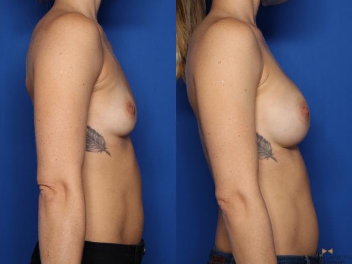 Before & After Breast Augmentation Case 482 Right Side View in Fort Worth & Arlington, Texas