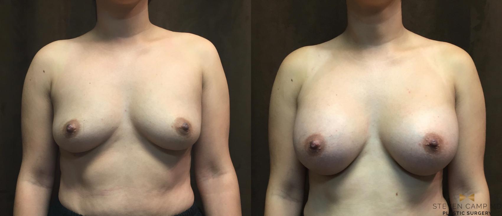 Before & After Breast Augmentation Case 49 View #1 View in Fort Worth, Texas