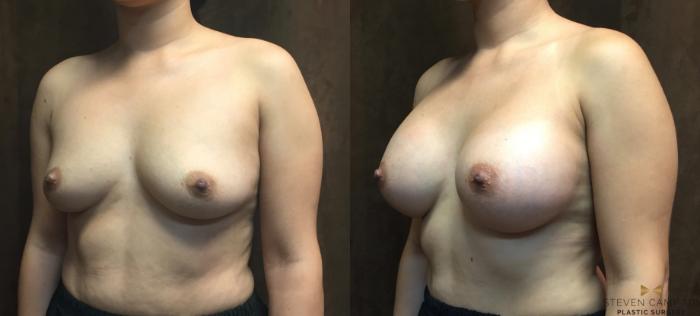 Before & After Breast Augmentation Case 49 View #2 View in Fort Worth, Texas