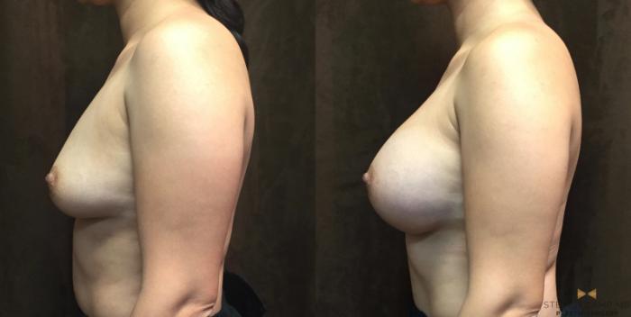 Before & After Breast Augmentation Case 49 View #3 View in Fort Worth, Texas