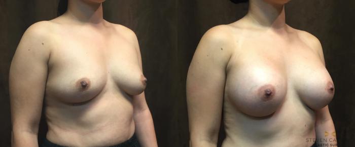 Before & After Breast Augmentation Case 49 View #4 View in Fort Worth, Texas