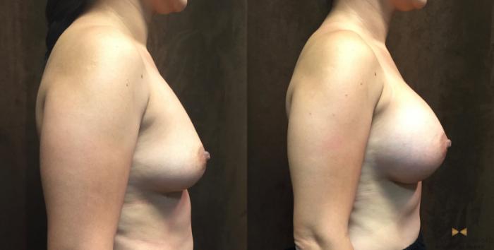 Before & After Breast Augmentation Case 49 View #5 View in Fort Worth, Texas