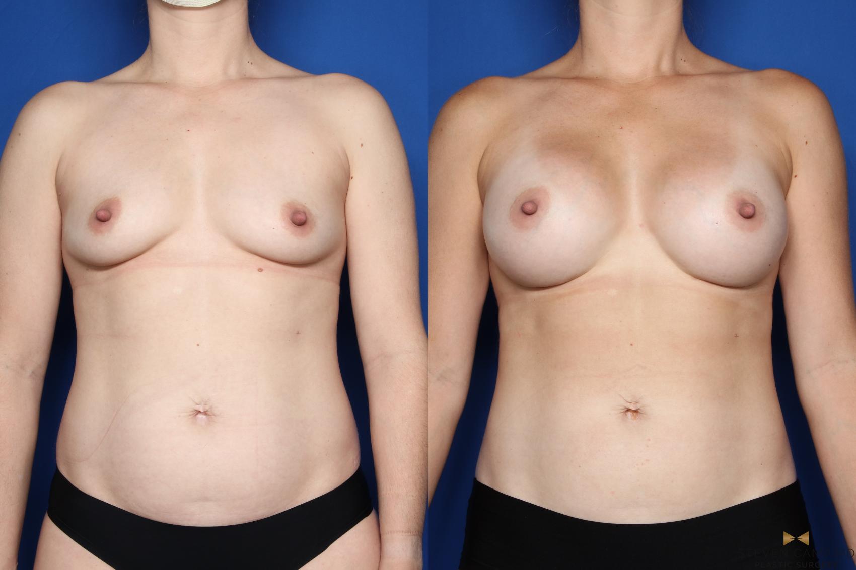 Before & After Breast Augmentation Case 492 Front View in Fort Worth, Texas