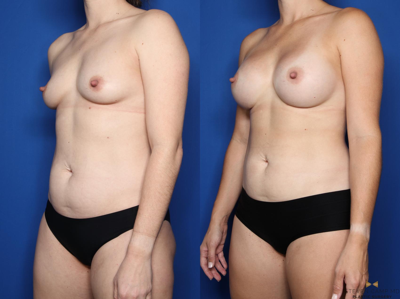 Before & After Breast Augmentation Case 492 Left Oblique View in Fort Worth, Texas