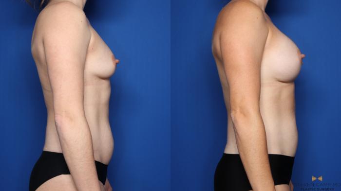 Before & After Breast Augmentation Case 492 Right Side View in Fort Worth, Texas