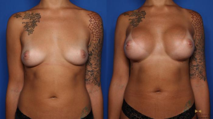 Before & After Breast Augmentation Case 494 Front View in Fort Worth & Arlington, Texas
