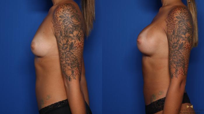 Before & After Breast Augmentation Case 494 Left Side View in Fort Worth & Arlington, Texas