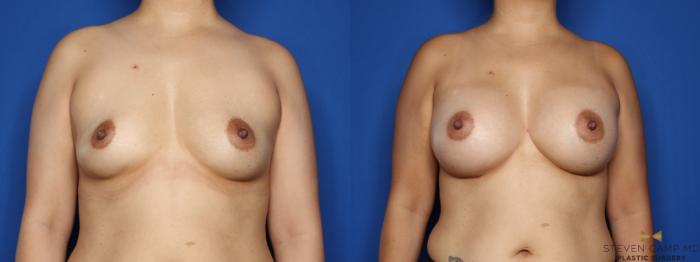 Before & After Breast Augmentation Case 496 Front View in Fort Worth & Arlington, Texas