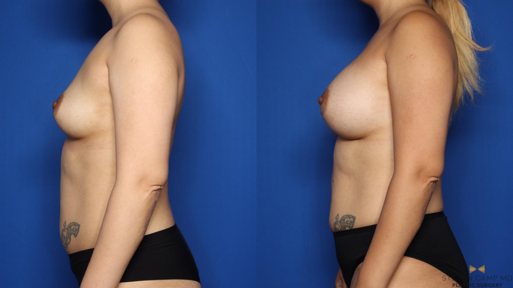 Before & After Breast Augmentation Case 496 Left Side View in Fort Worth & Arlington, Texas