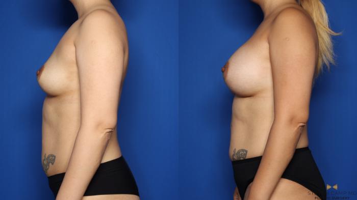 Before & After Breast Augmentation Case 496 Left Side View in Fort Worth & Arlington, Texas
