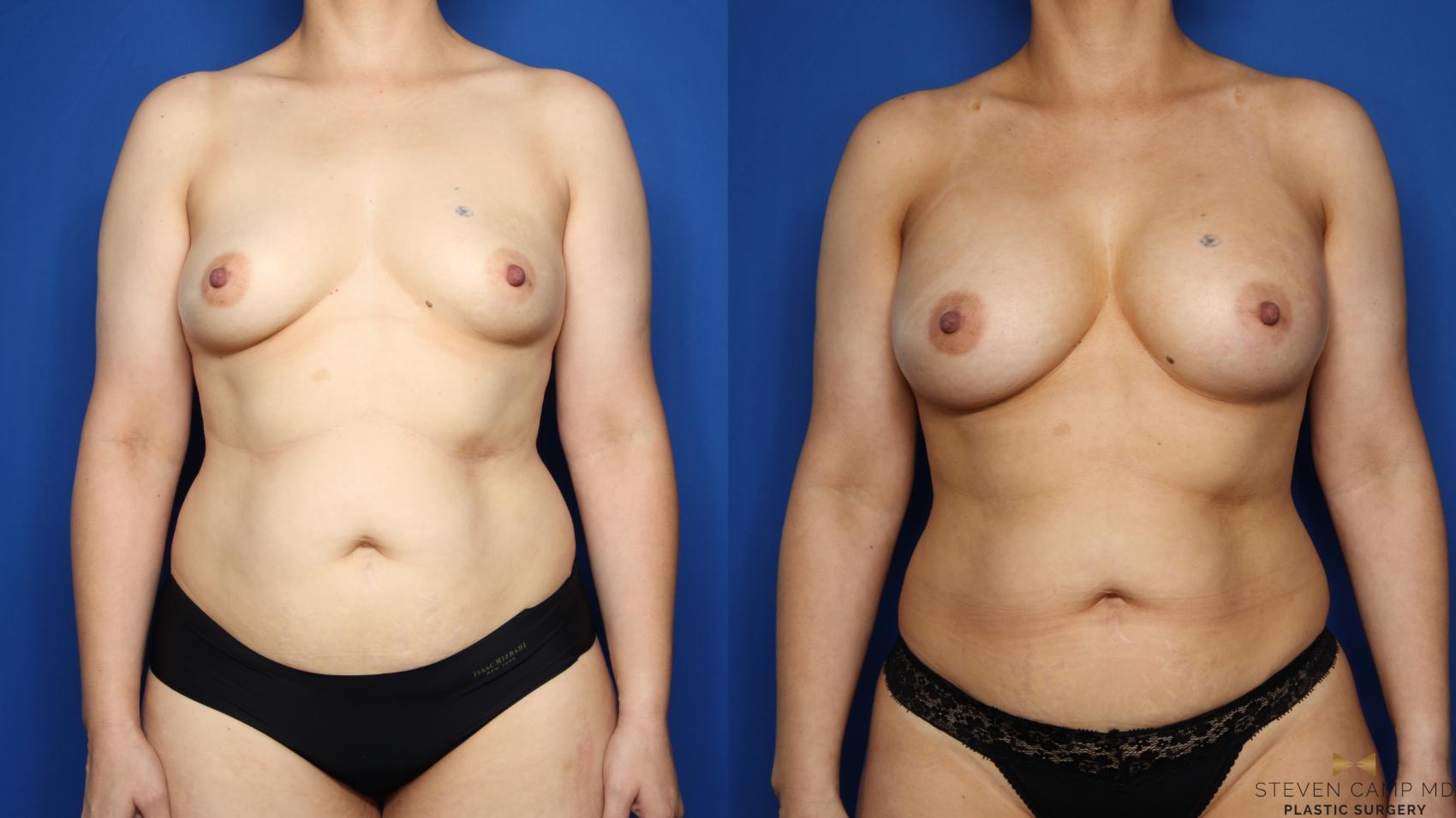 Before & After Breast Augmentation Case 521 Front View in Fort Worth & Arlington, Texas