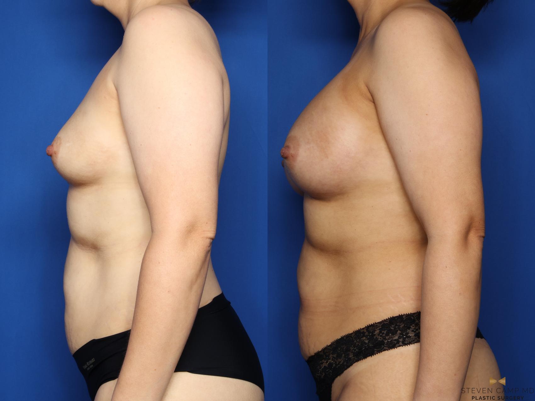 Before & After Breast Augmentation Case 521 Left Side View in Fort Worth & Arlington, Texas