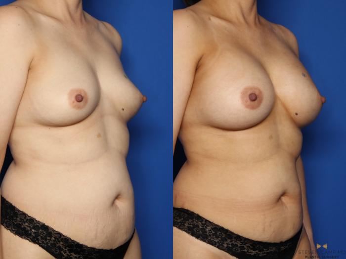 Before & After Breast Augmentation Case 521 Right Oblique View in Fort Worth & Arlington, Texas