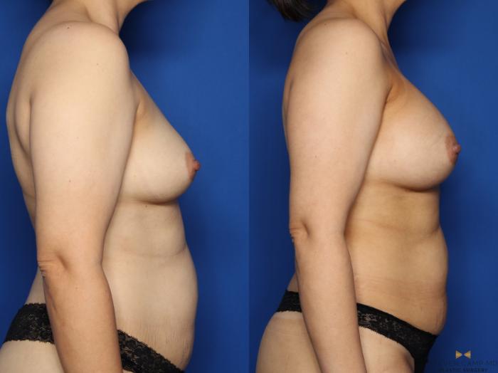Before & After Breast Augmentation Case 521 Right Side View in Fort Worth & Arlington, Texas