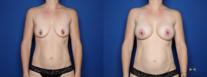 Before & After Breast Augmentation Case 540 Front View in Fort Worth, Texas