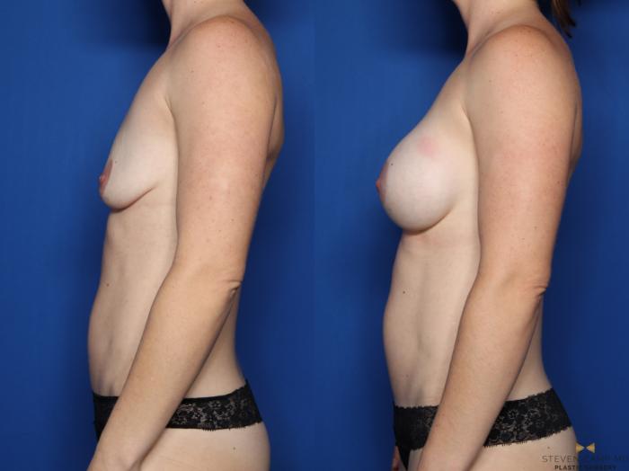 Before & After Breast Augmentation Case 540 Left Side View in Fort Worth & Arlington, Texas
