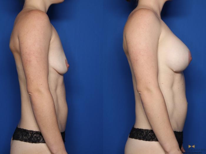 Before & After Breast Augmentation Case 540 Right Side View in Fort Worth, Texas