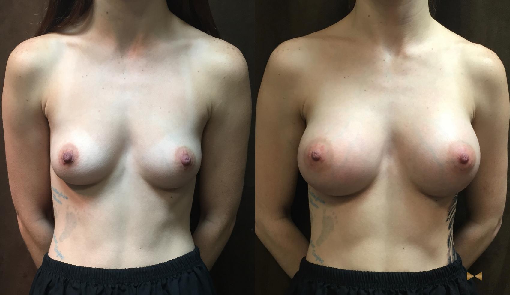 Before & After Breast Augmentation Case 55 View #1 View in Fort Worth, Texas