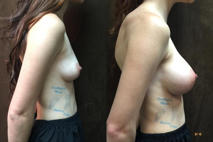 Before & After Breast Augmentation Case 55 View #5 View in Fort Worth, Texas