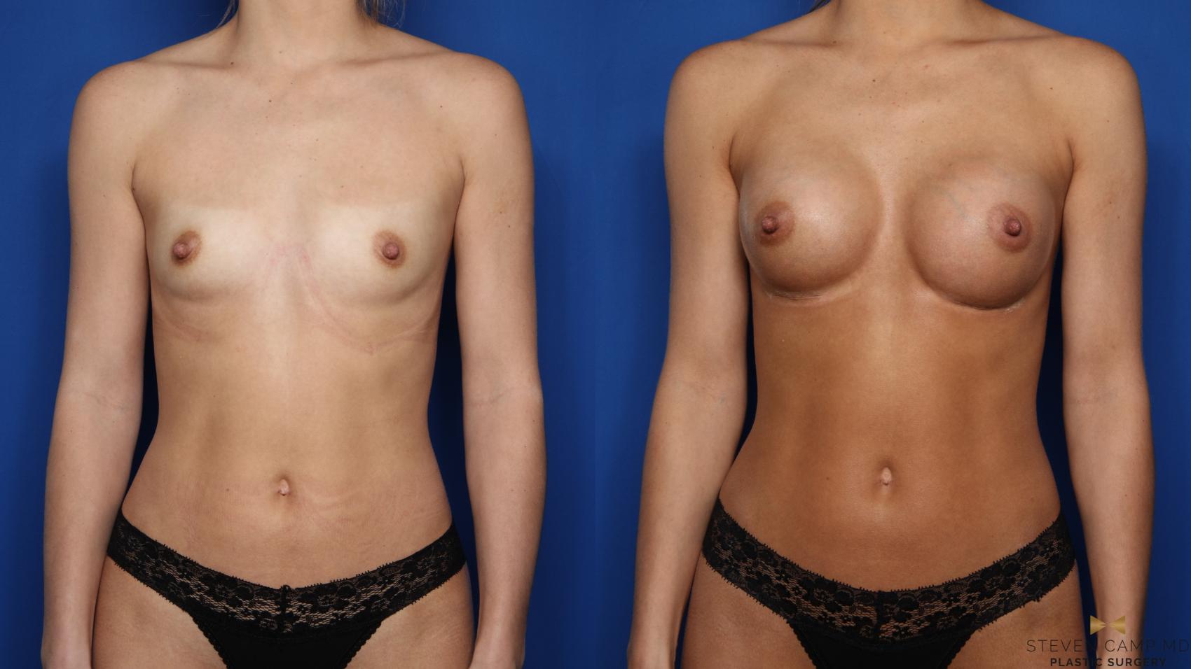Before & After Breast Augmentation Case 550 Front View in Fort Worth, Texas