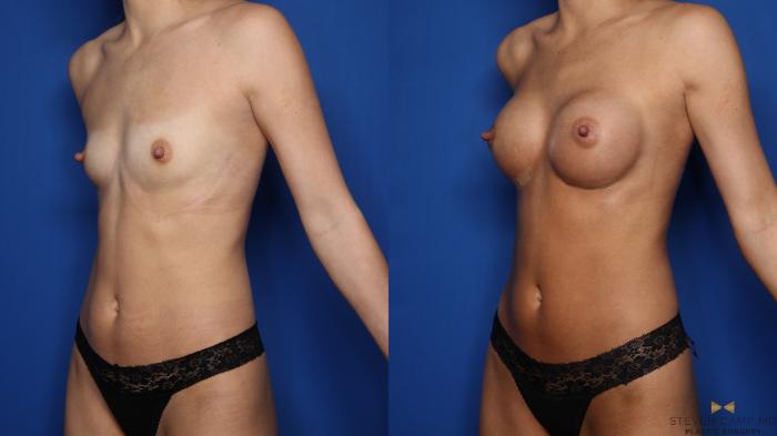 Before & After Breast Augmentation Case 550 Left Oblique View in Fort Worth, Texas