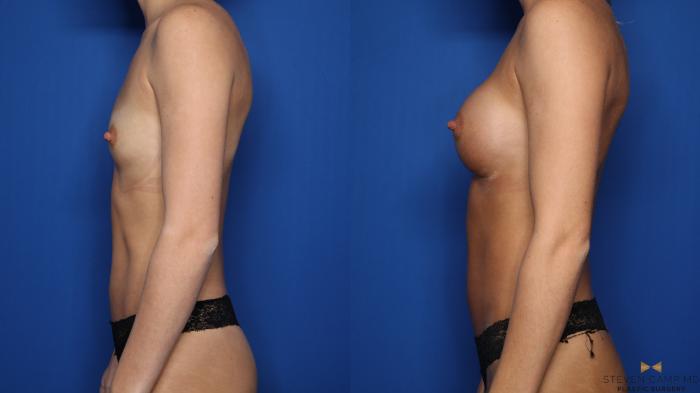 Before & After Breast Augmentation Case 550 Left Side View in Fort Worth & Arlington, Texas