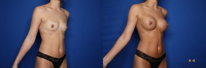 Before & After Breast Augmentation Case 550 Right Oblique View in Fort Worth & Arlington, Texas