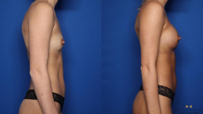 Before & After Breast Augmentation Case 550 Right Side View in Fort Worth & Arlington, Texas
