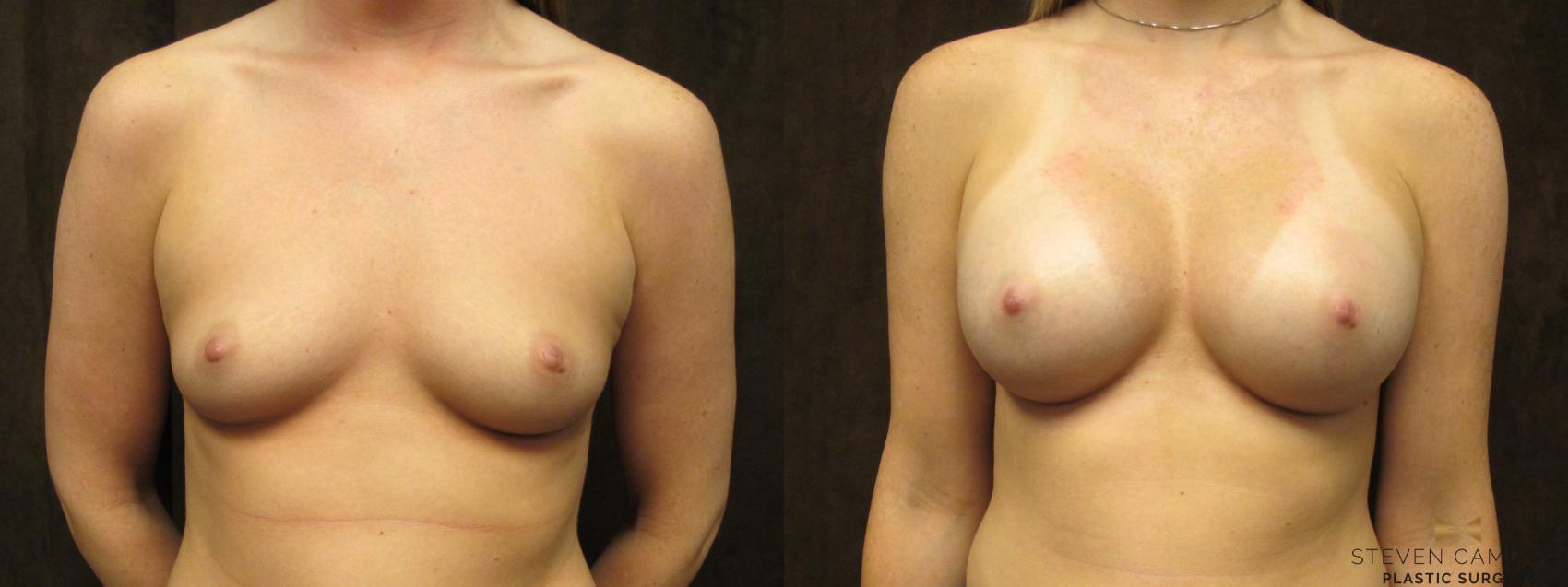 Before & After Breast Augmentation Case 56 View #1 View in Fort Worth, Texas