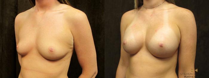 Before & After Breast Augmentation Case 56 View #2 View in Fort Worth, Texas