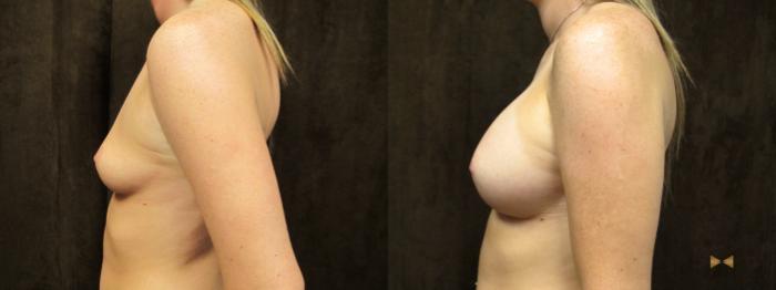 Before & After Breast Augmentation Case 56 View #3 View in Fort Worth, Texas