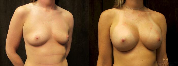 Before & After Breast Augmentation Case 56 View #4 View in Fort Worth & Arlington, Texas