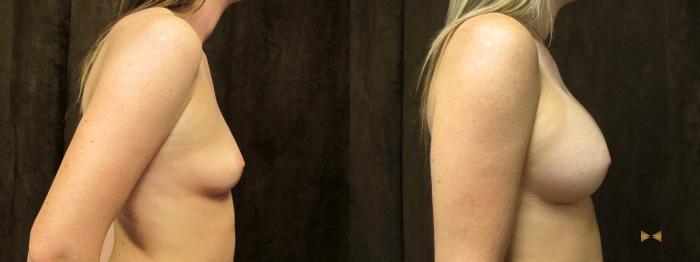Before & After Breast Augmentation Case 56 View #5 View in Fort Worth & Arlington, Texas