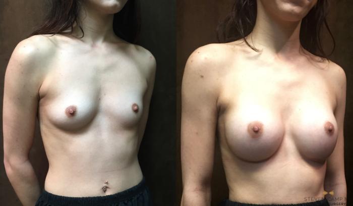 Before & After Breast Augmentation Case 57 View #4 View in Fort Worth, Texas