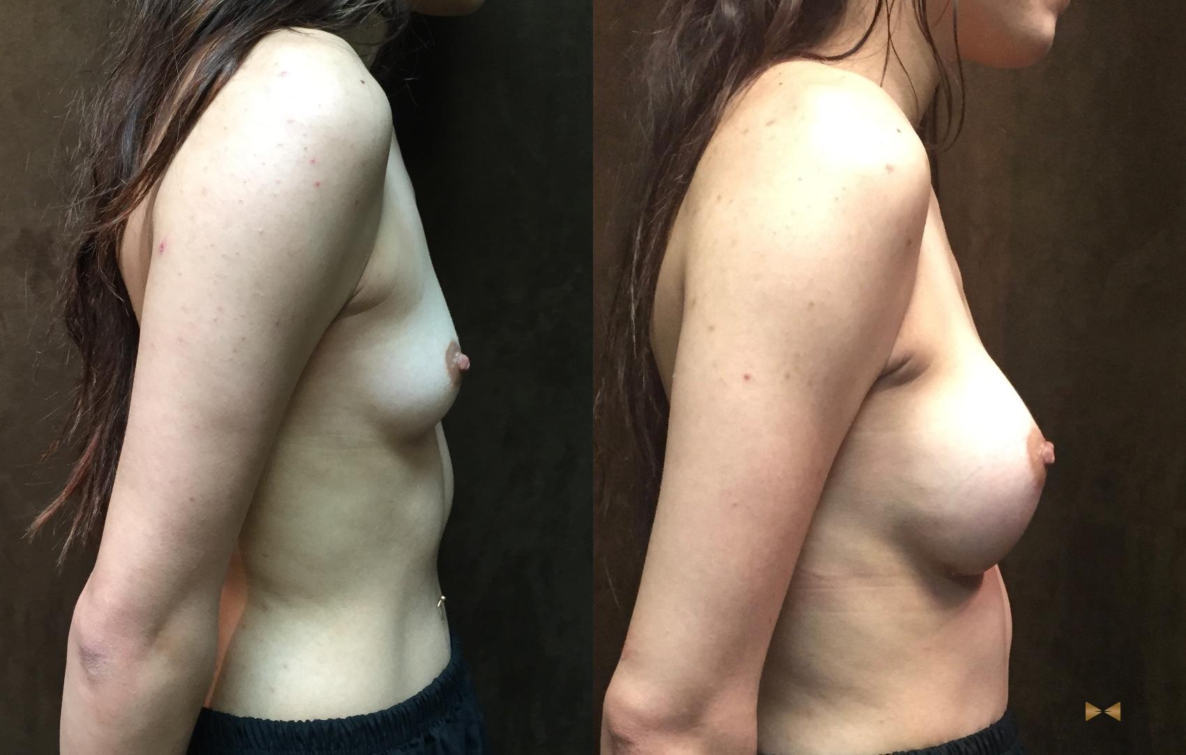 Before & After Breast Augmentation Case 57 View #5 View in Fort Worth, Texas