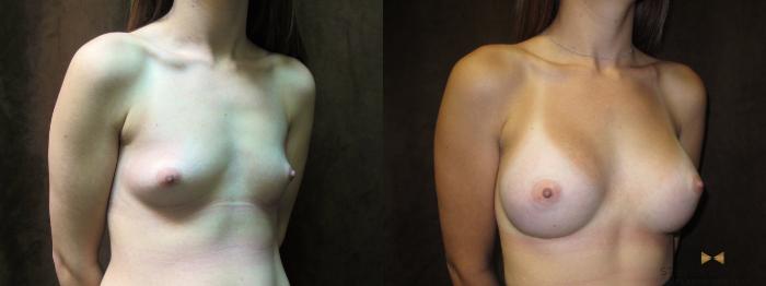 Before & After Breast Augmentation Case 58 View #1 View in Fort Worth, Texas