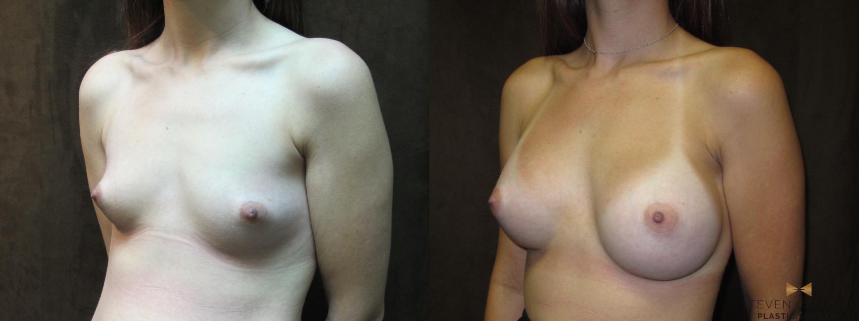 Before & After Breast Augmentation Case 58 View #2 View in Fort Worth, Texas